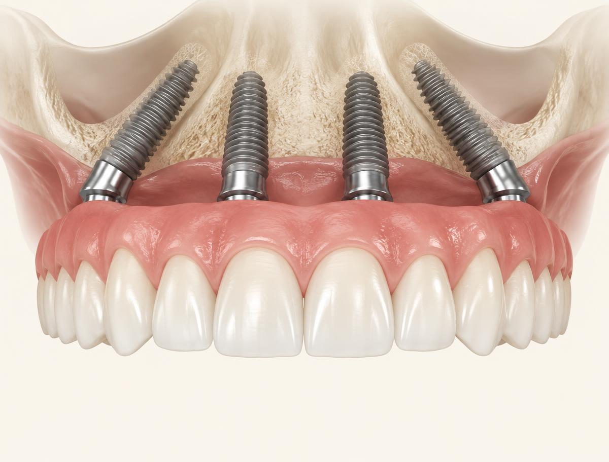 Full arch of fixed teeth anchored to four titanium implants
